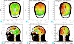 Traumatic brain injury simulation