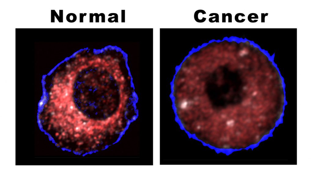 Proof positive — The difference between a normal and cancerous liver cell is shown clearly by the location of mitochondria, as revealed by Sandia's biocavity laser. The healthy cell shows very few mitochondria near the outer cell wall; they cluster densely (red coloration) as they approach the cell's nucleous (depicted here as the black central hole). In the cancerous cell, the mitochondria are spread throughout the cell, do not cluster, and under the same lighting produce a more subdued effect.